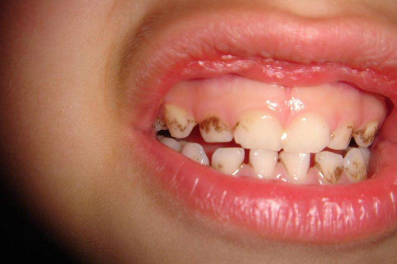 孩子牙齿上的黑色斑点是什么?