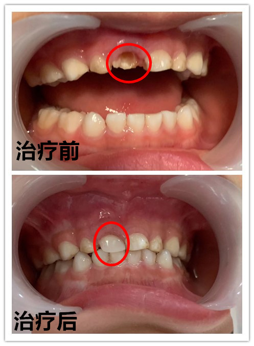 这个"儿童补牙神器 让5岁男童门牙失而复得